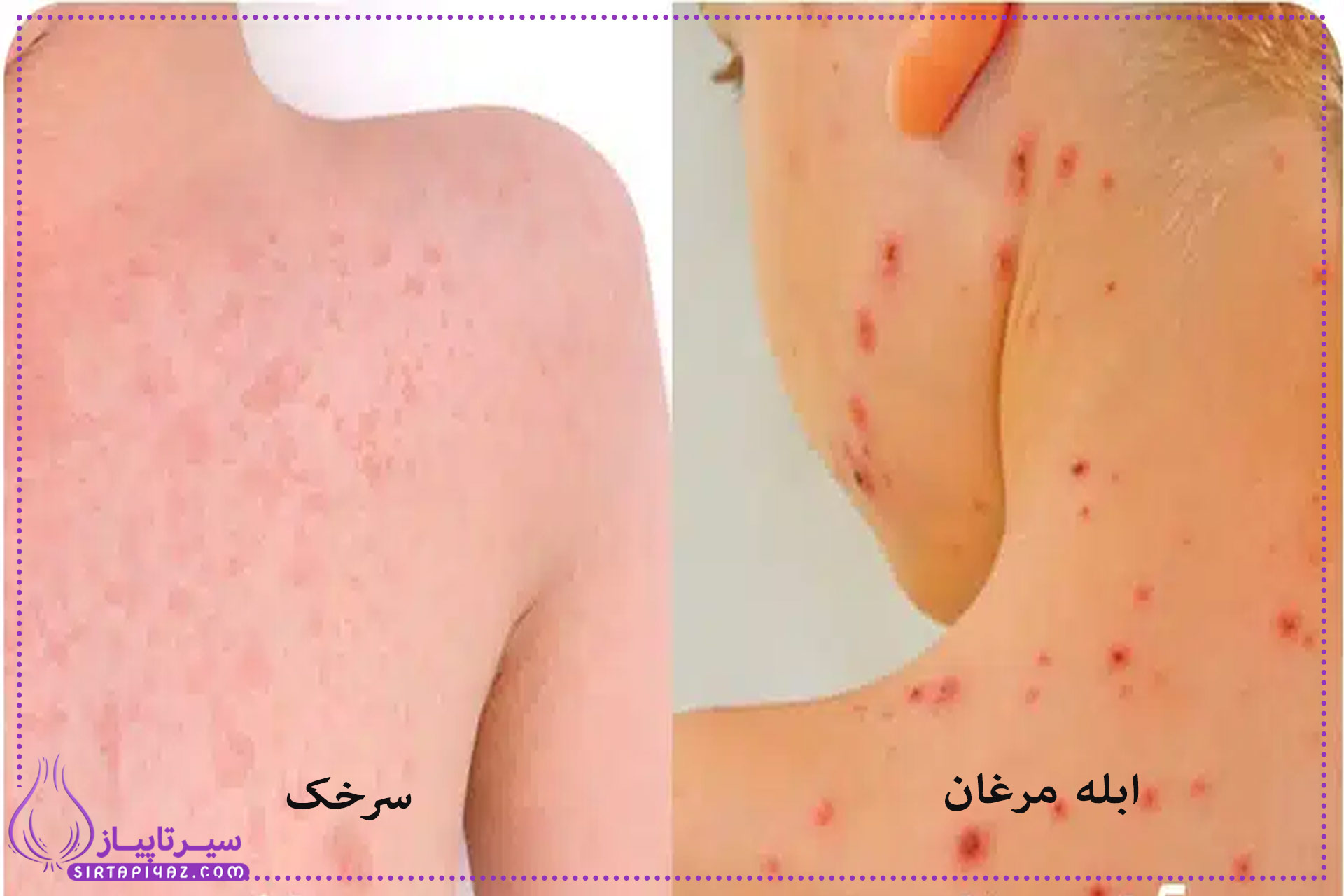 تفاوت ابله مرغان و سرخک در چیست؟