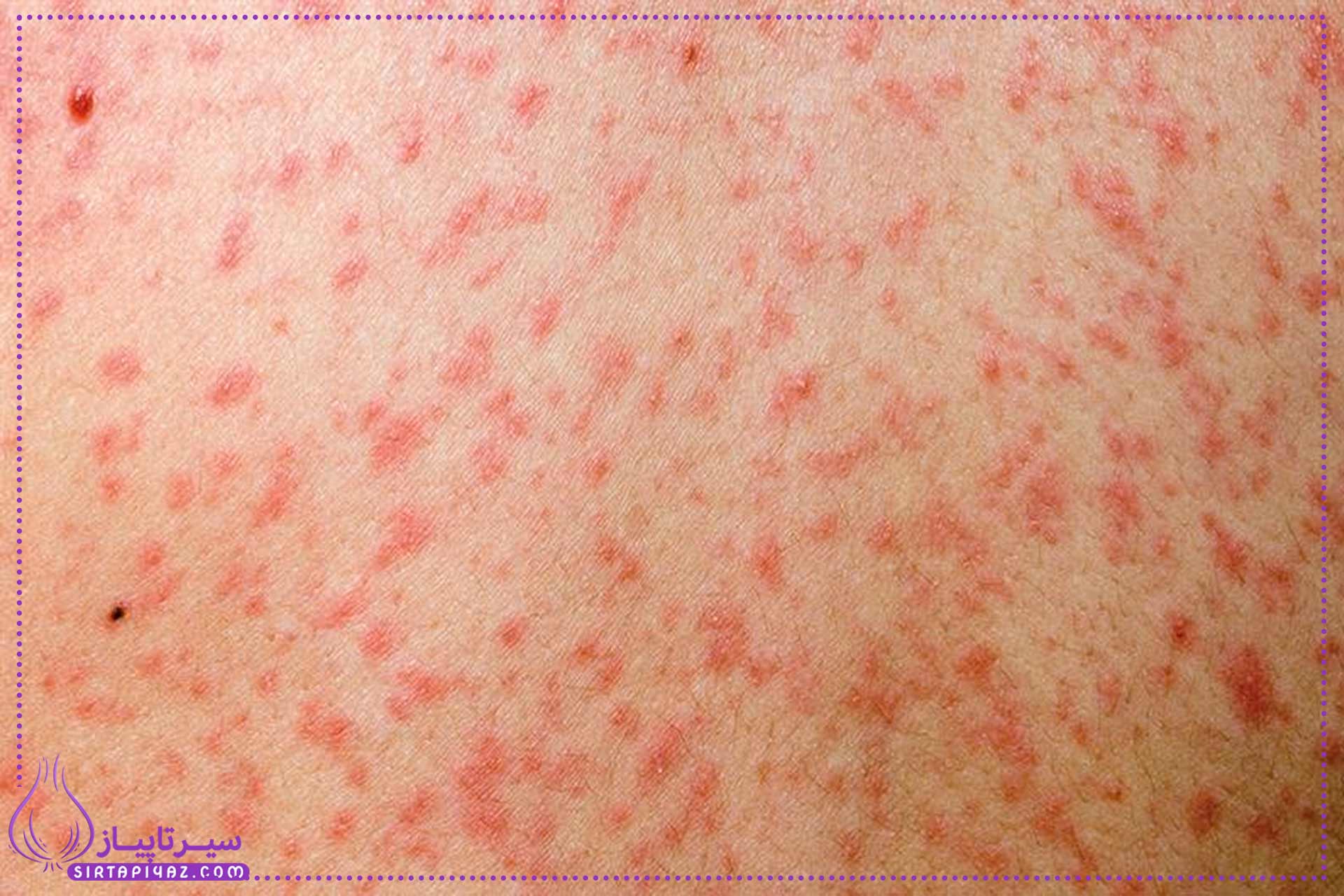 علائم سرخک و پیشگیری  و درمان