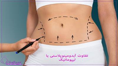 لیپوماتیک یا ابدومینوپلاستی؟ کدام روش برای شما مناسب‌تر است