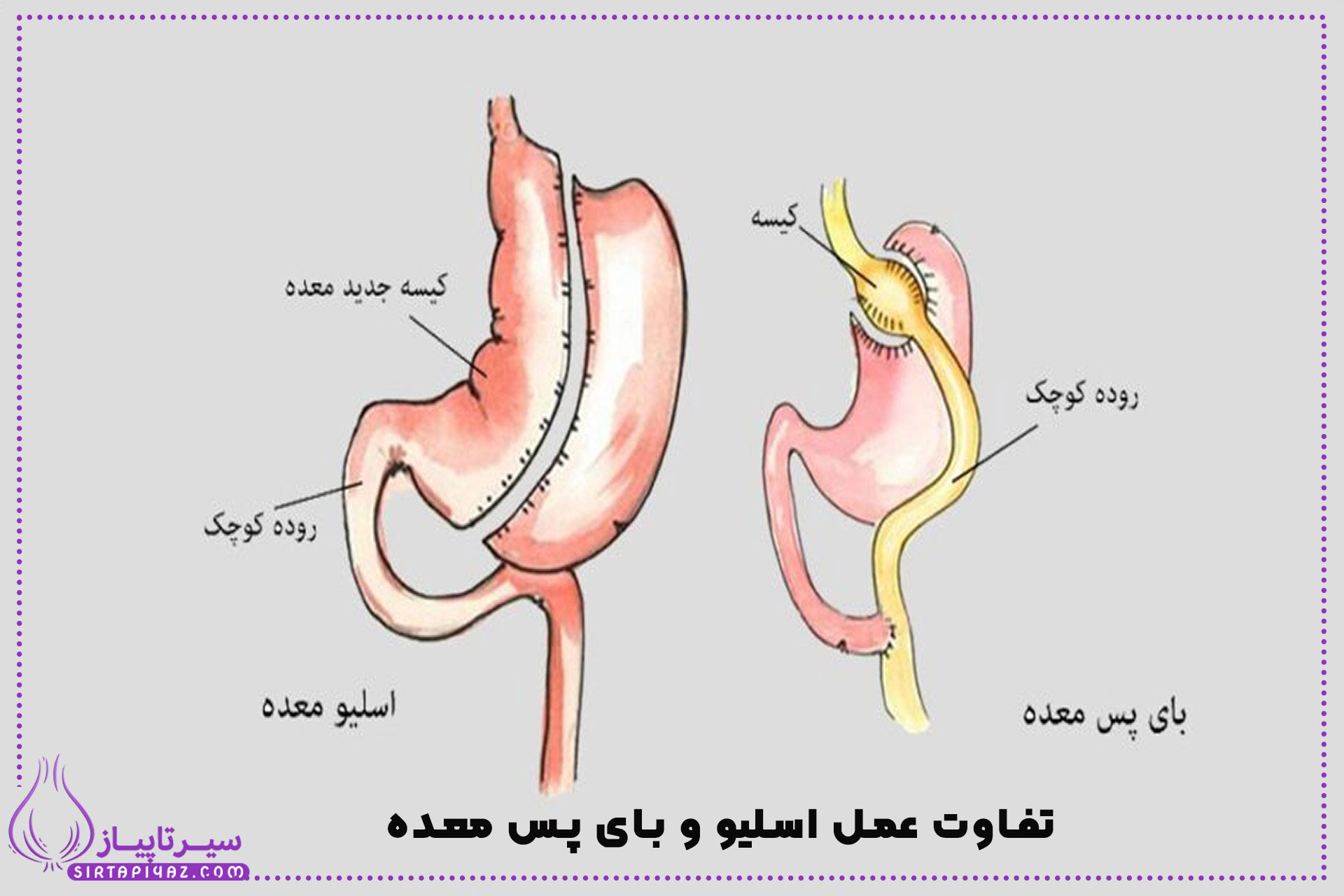 مقایسه کامل عمل اسلیو و بای‌پس معده | مزایا، معایب و نتایج هر روش