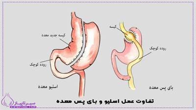 تفاوت‌ عمل اسلیو و بای‌پس معده: مزایا، معایب، نتایج