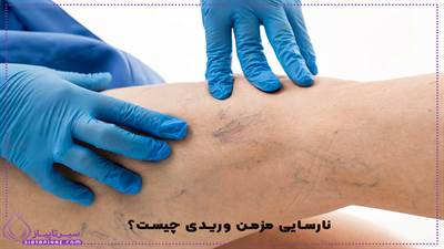 نارسایی مزمن وریدی چیست؟ علائم، علت‌ها و بهترین روش‌های درمان