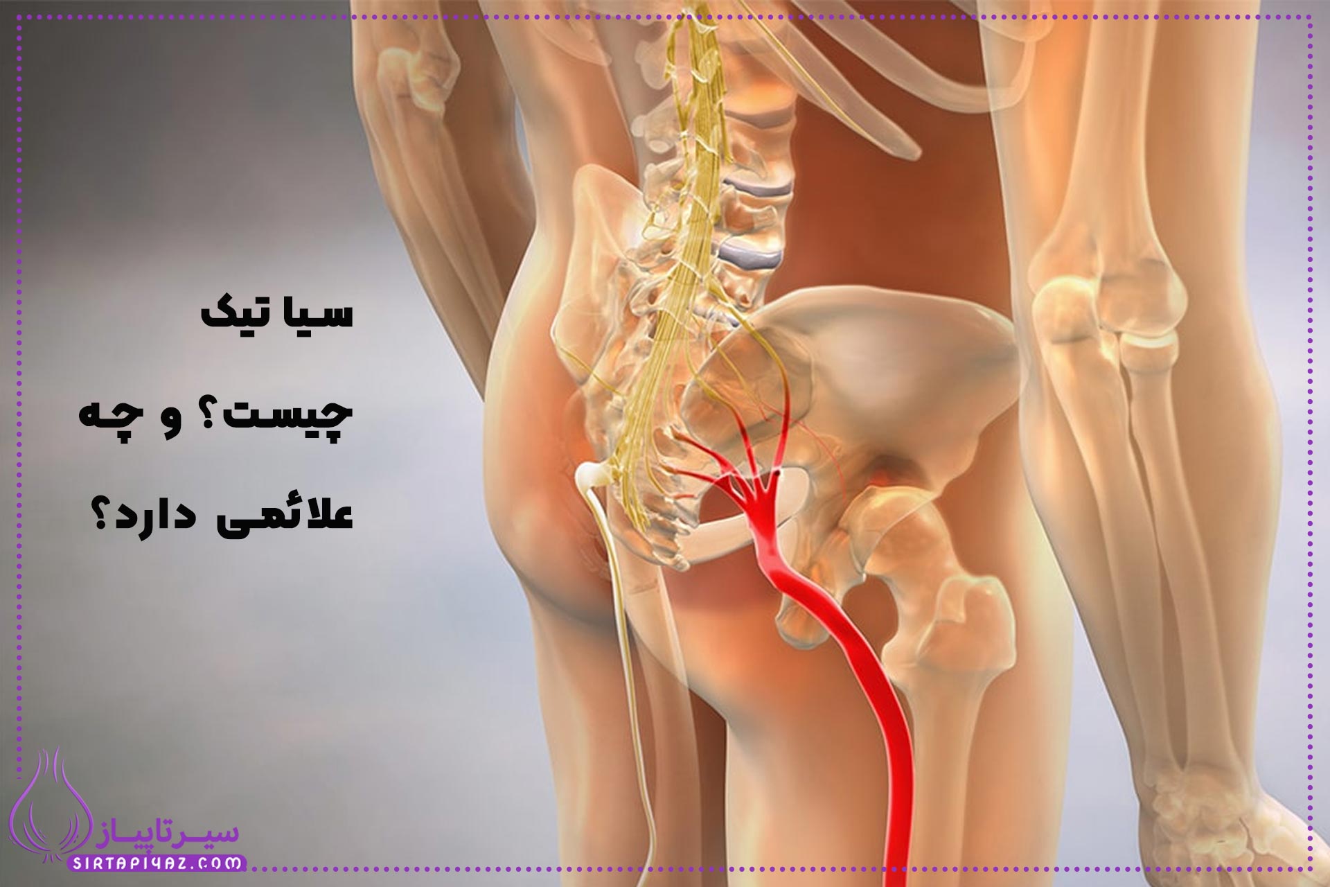 همه چیز درباره عصب سیاتیک و مشکلات آن + راه های درمان همه چیز درباره عصب سیاتیک و مشکلات آن + راه های درمان