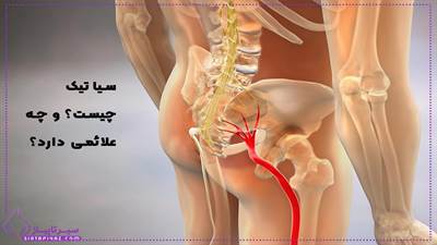 سیاتیک چیست و چه علائمی دارد؟ | راه های درمان آن