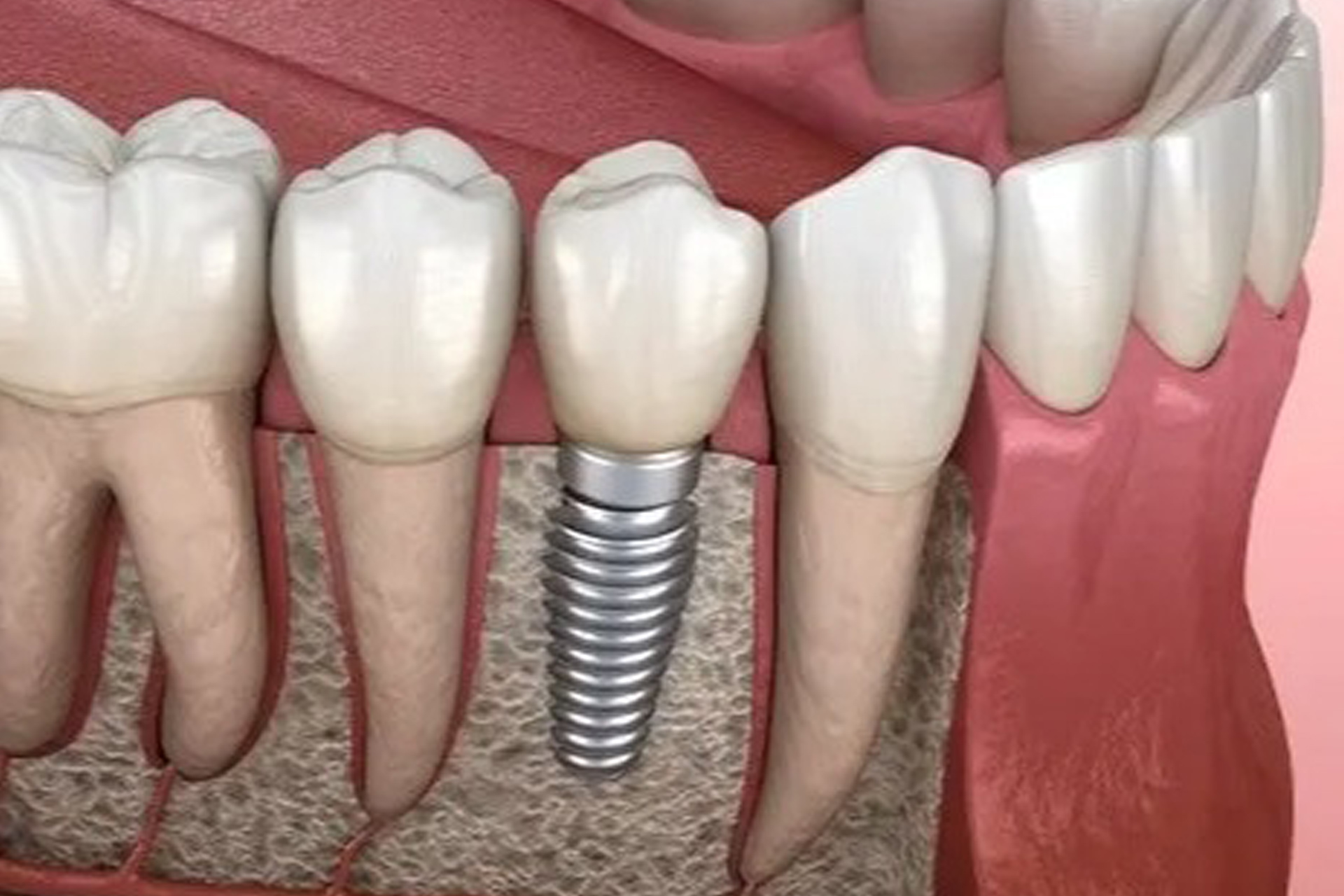 ایمپلنت دیجیتال چیست؟ از اسکن سه‌بعدی تا گاید جراحی 