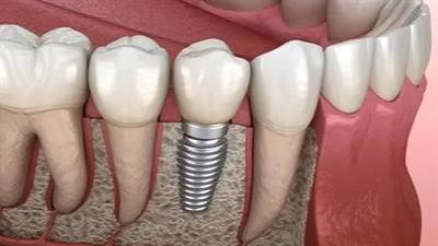 ایمپلنت دیجیتال چیست؟ از اسکن سه‌بعدی تا گاید جراحی 