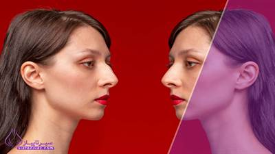 قوز بینی - ترند زیبایی 2026 | از جراحی تا آرایش