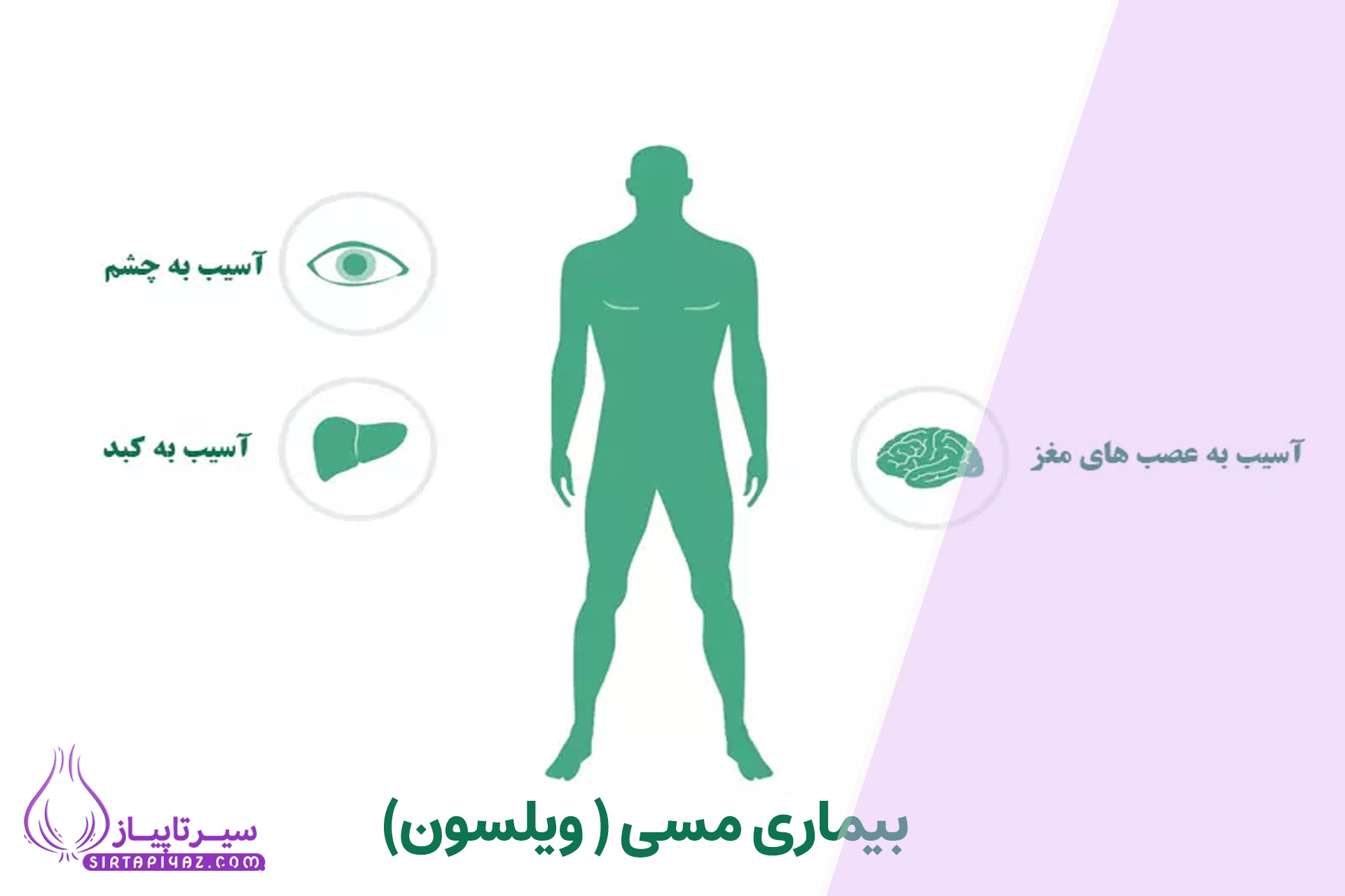 بیماری مسی ( ویلسون) چیست؟ | علائم، تشخیص و درمان قطعی