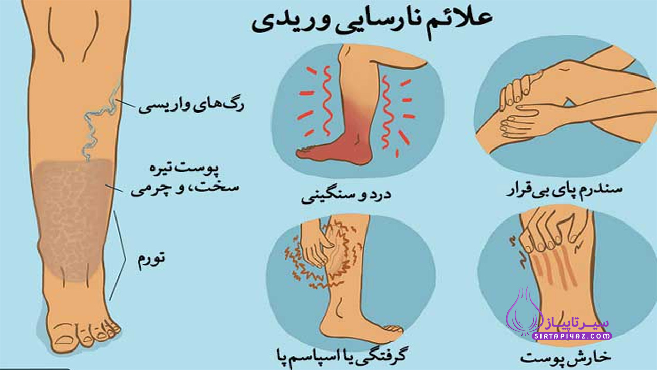 علائم نارسایی وریدی 