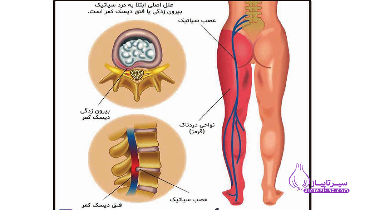 سیاتیک چیست؟ و راه های درمان آن