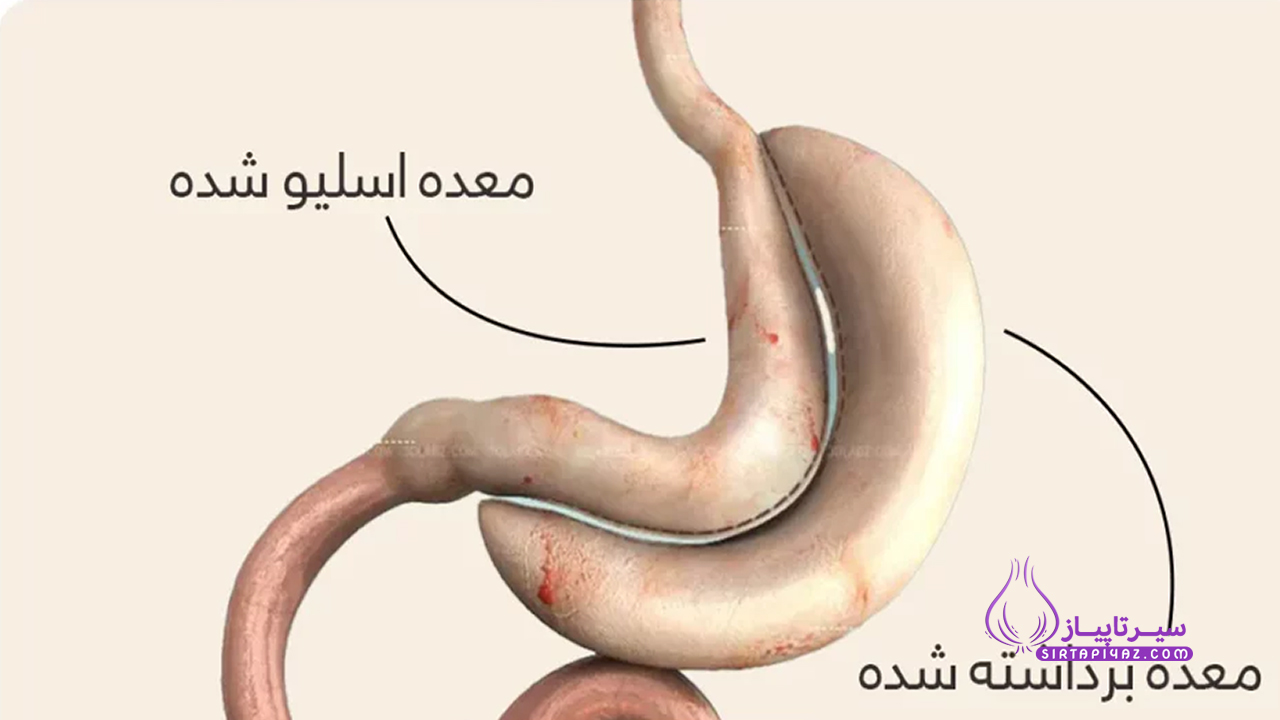 تصویر توضیحی عمل اسلیو معده