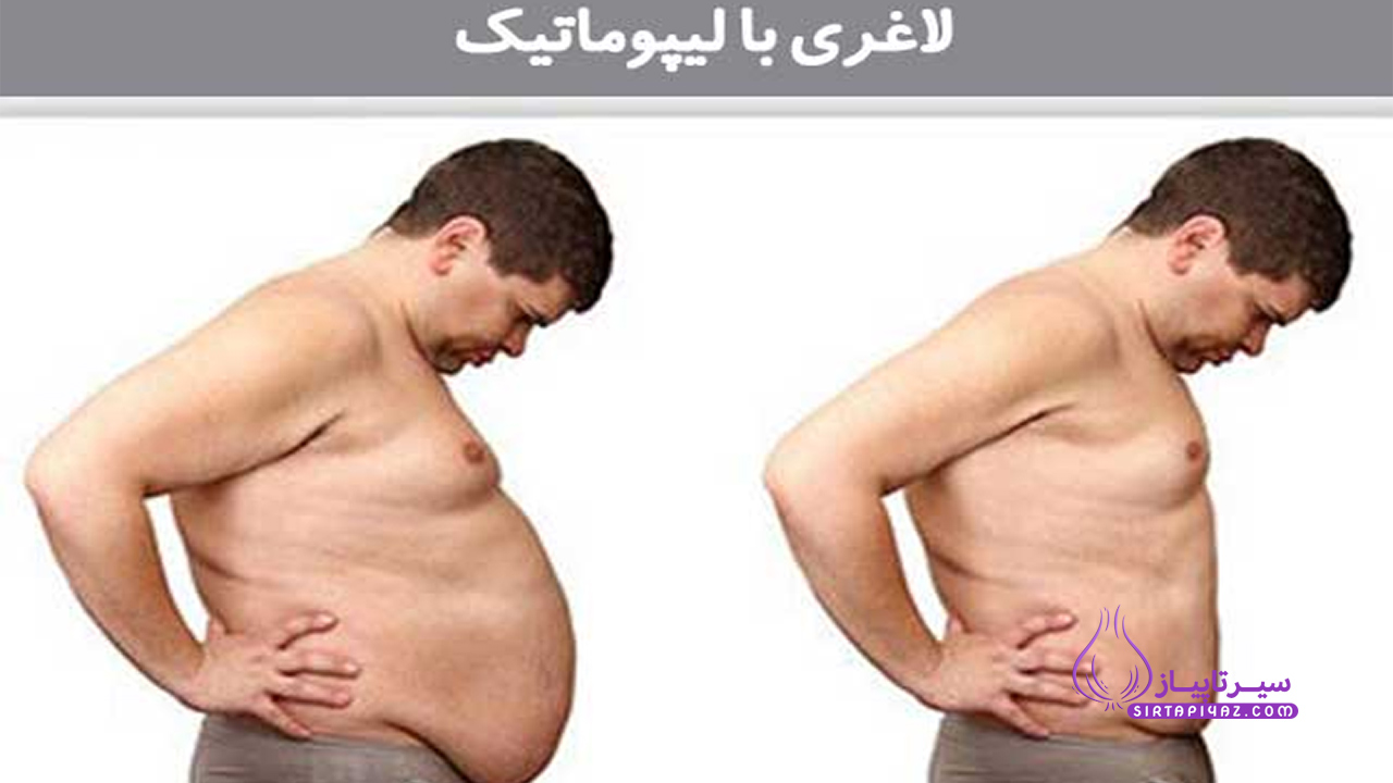 لاغری با لیپوماتیک