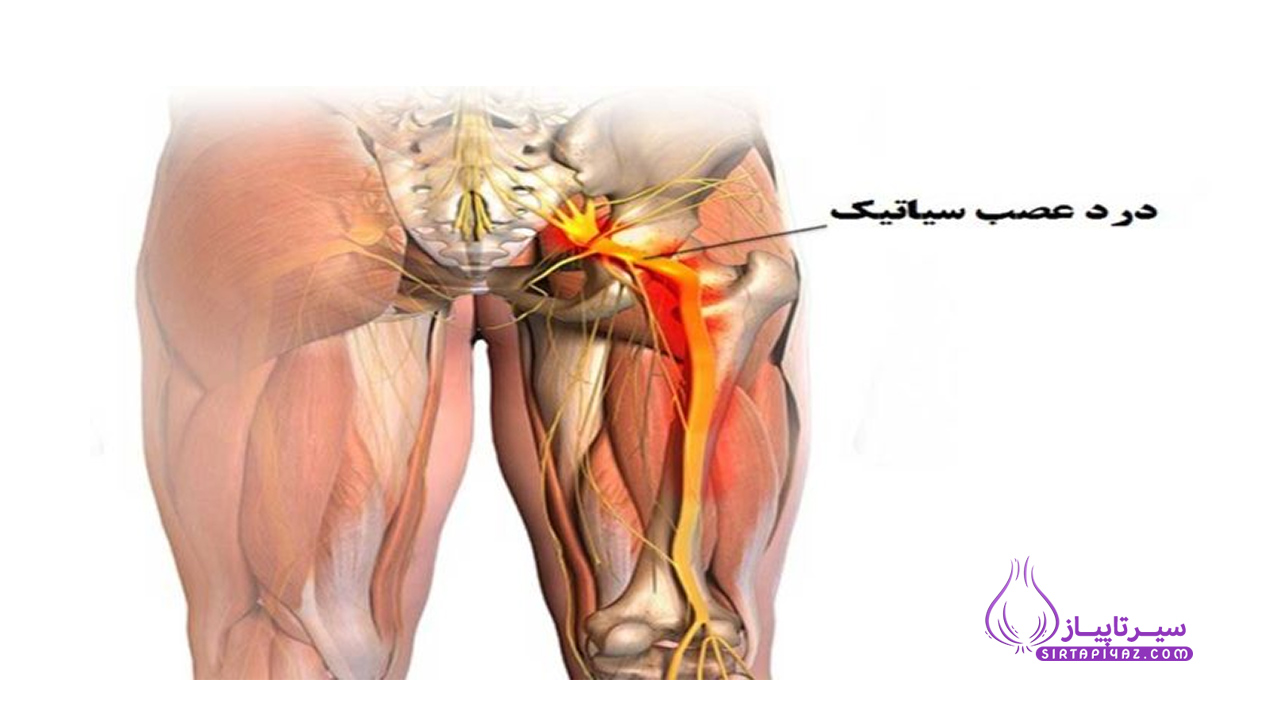همه چیز در مورد در عصب سیاتیک